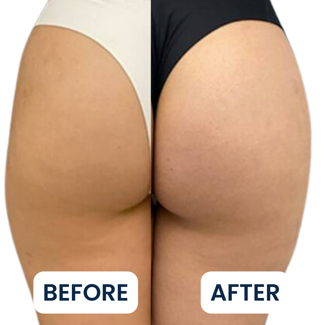Buttlift-BA-1