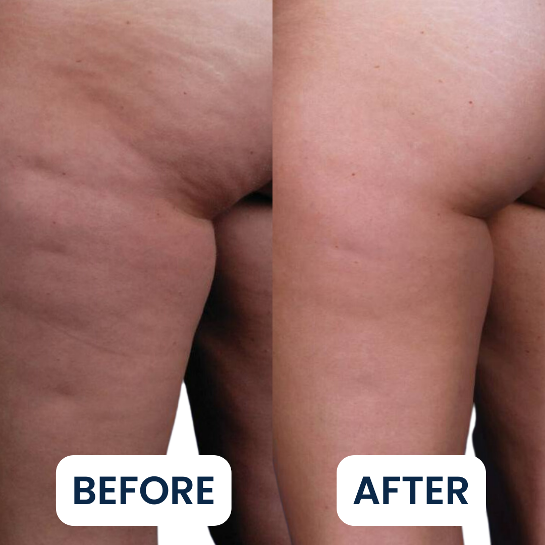 Buttlift-BA