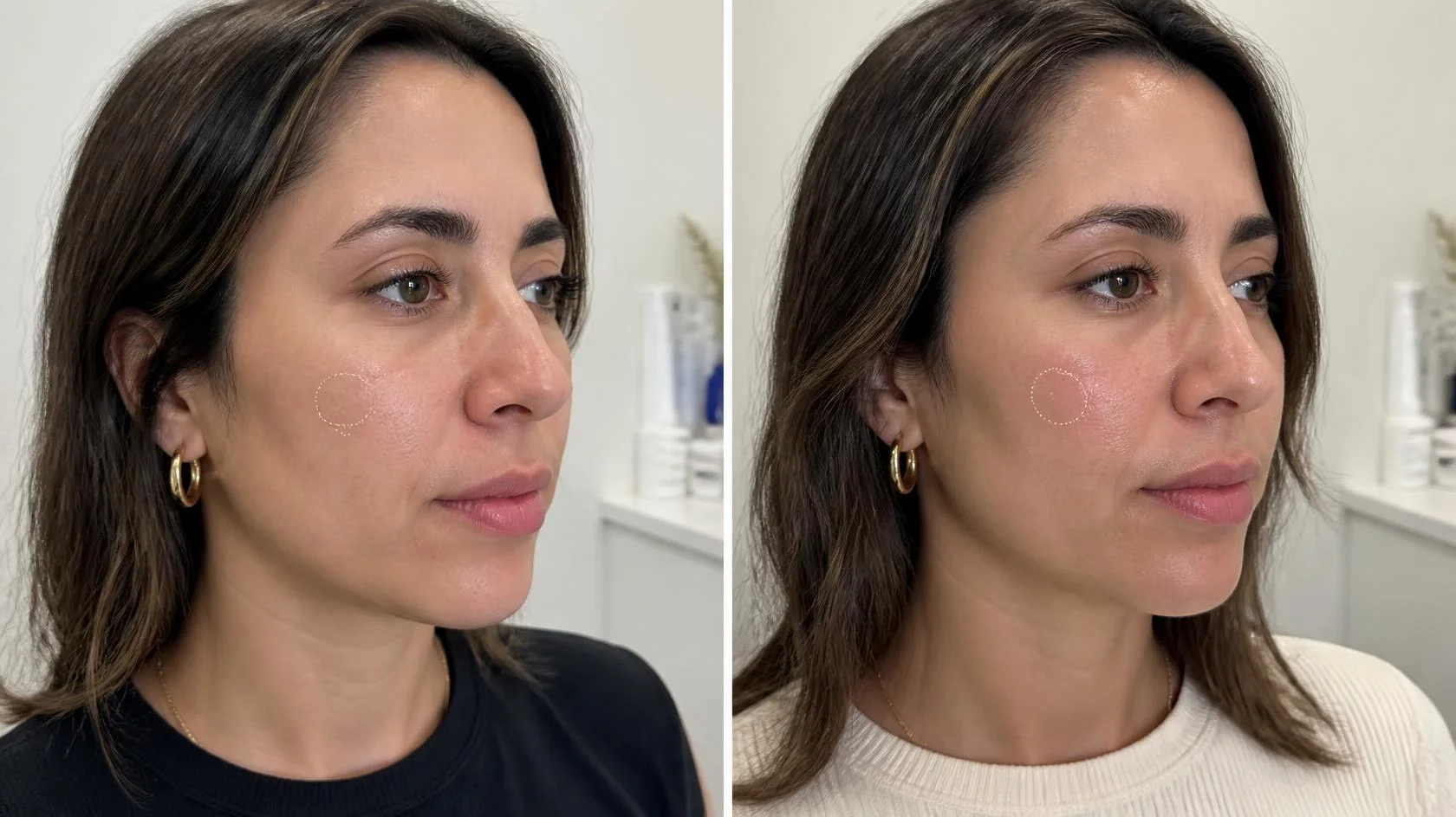 Cheeks Dermal Filler Result (3)