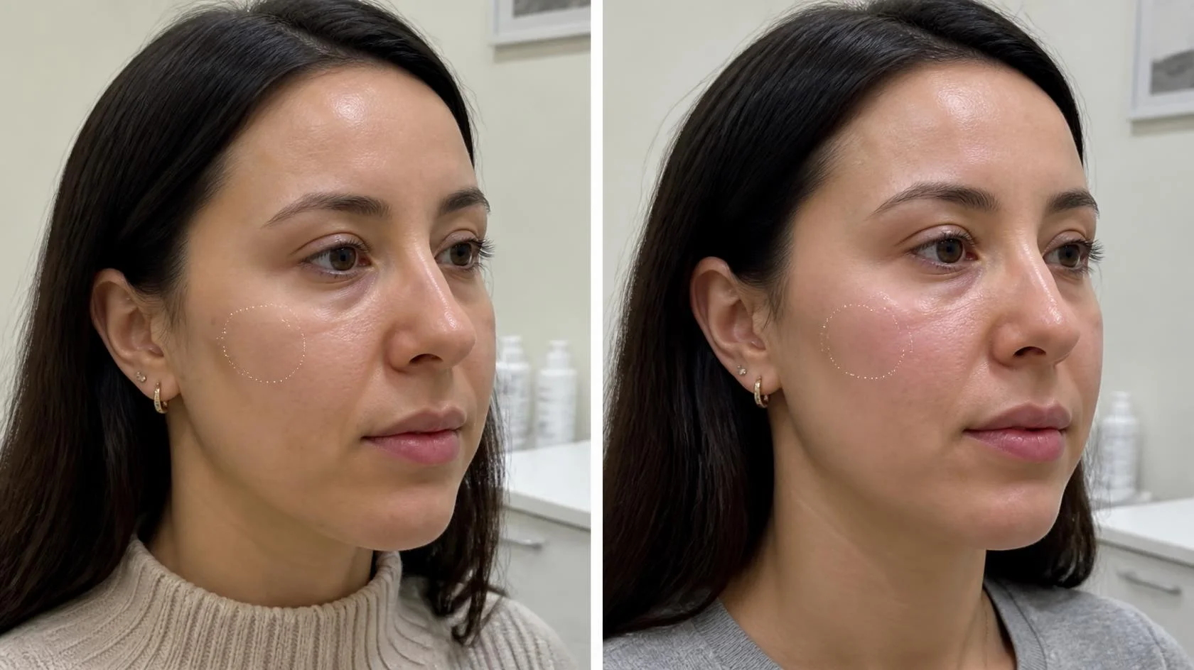 Cheeks Dermal Filler Result
