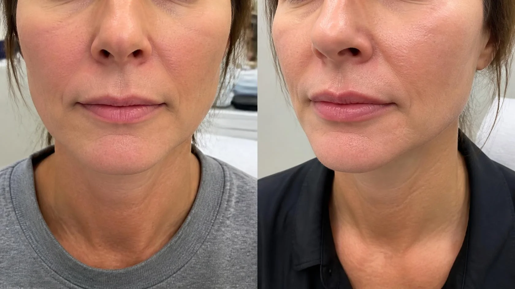Versa dermal filler lips
