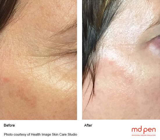 microneedling-2