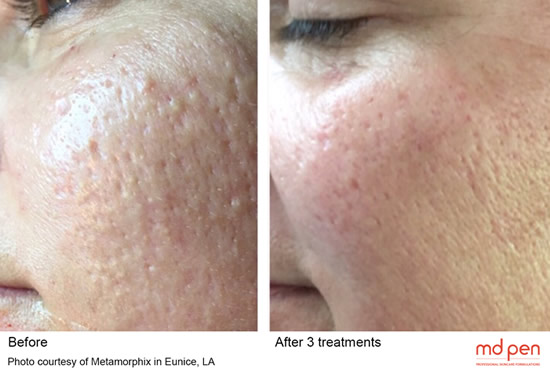 microneedling-3