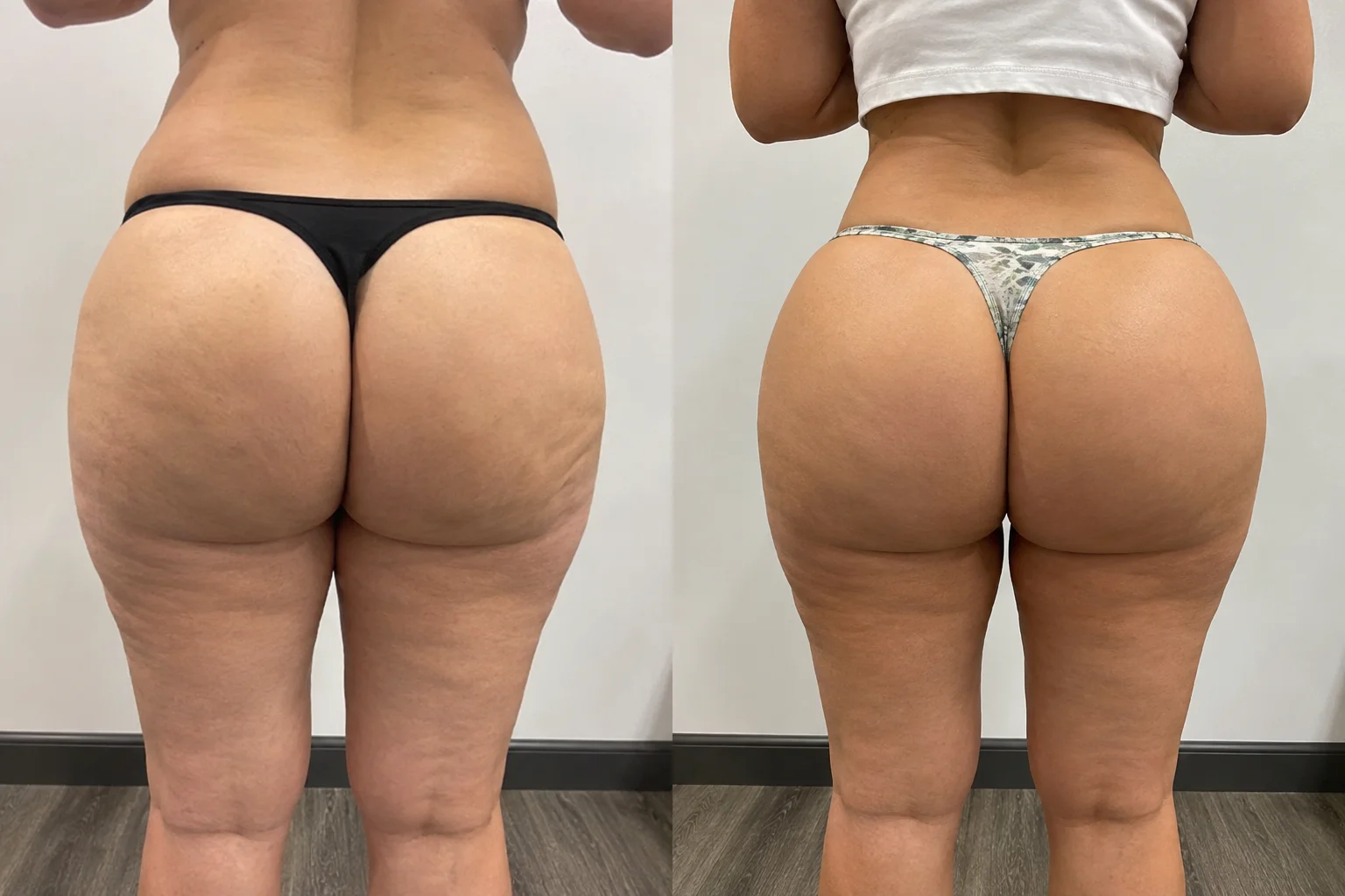 radiesse buttlift (2)