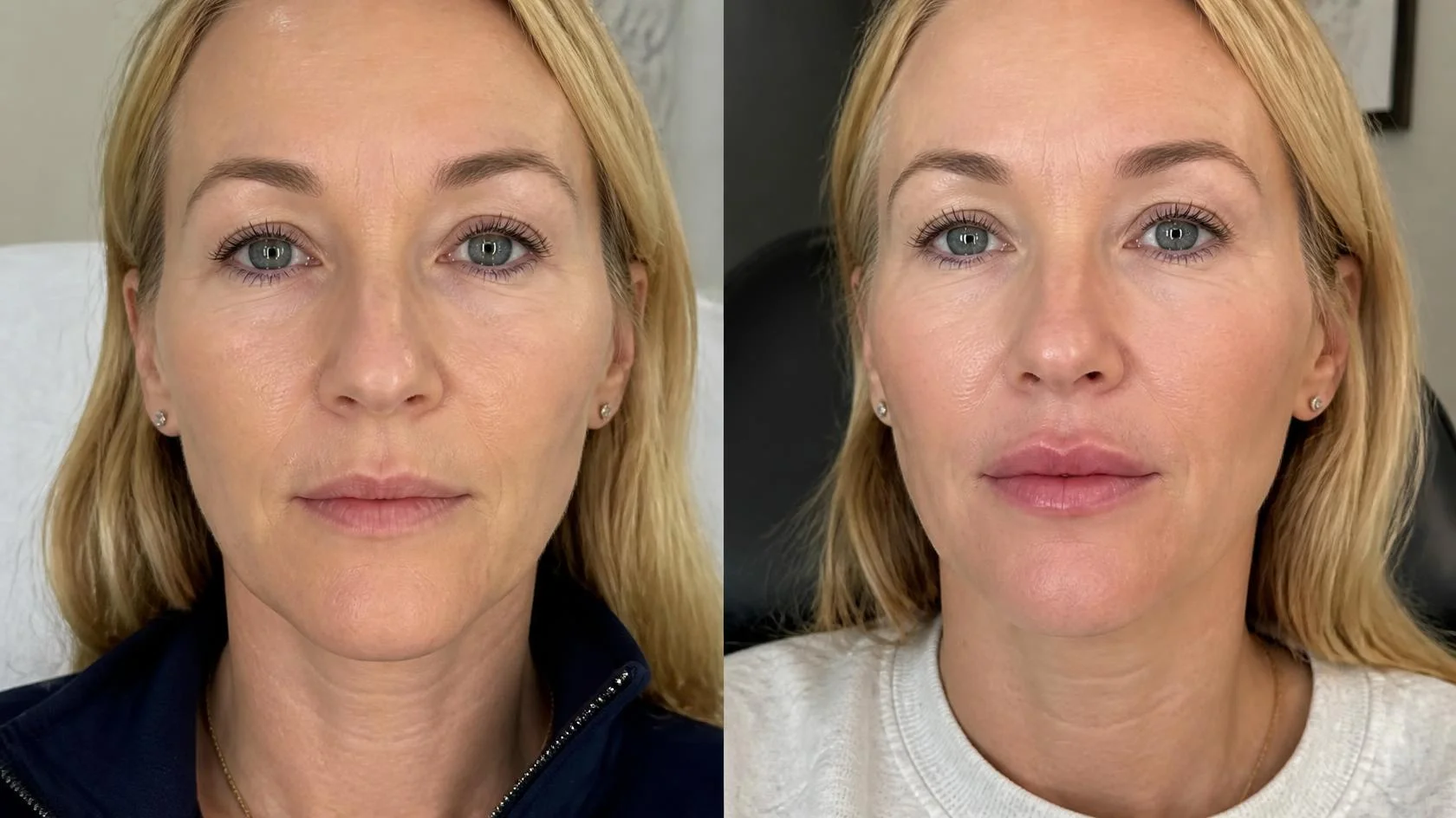 radiesse-dermal-filler before after (2)