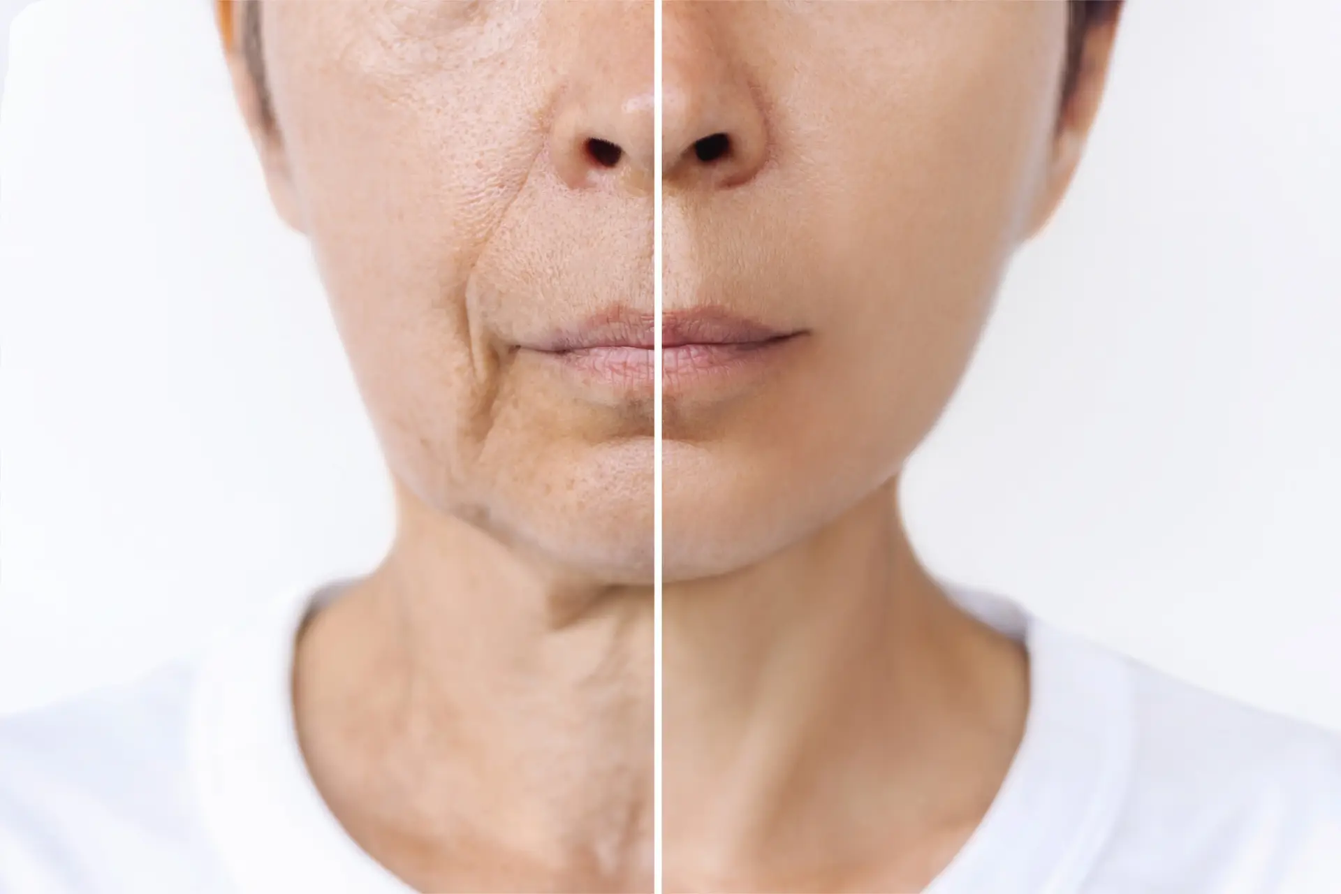 radiesse treatment